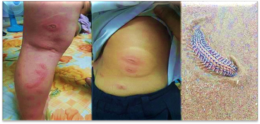 สัตว์ทะเลมีพิษและวิธีการปฐมพยาบาล