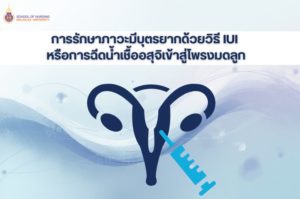 การรักษาภาวะมีบุตรยากด้วยวิธี IUI หรือการฉีดน้ำเชื้ออสุจิเข้าสู่โพรงมดลูก